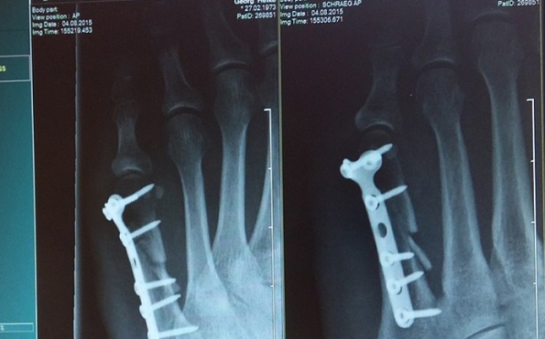 Osteoporózu často odhalí až zlomenina. ZP MV ČR proto přispívá na speciální vyšetření